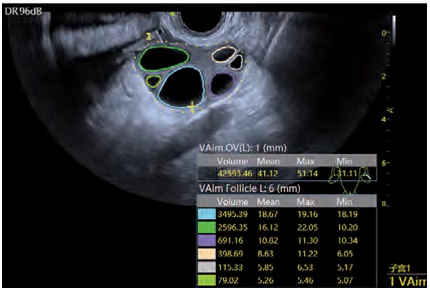 M&aacute;y si&ecirc;u &acirc;m 5D Vinno G65 - Tr&iacute; tuệ nh&acirc;n tạo AI