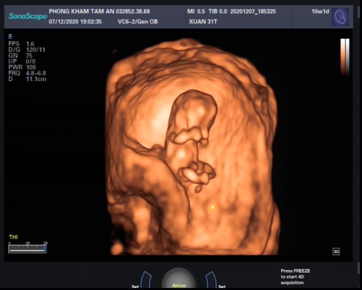 Hình ảnh siêu âm 5D thai 9 tuần tuổi? Siêu âm thai nhi 9 tuần tuổi
