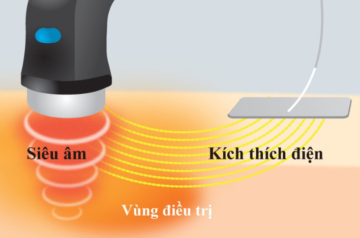 Siêu âm trị liệu là gì ?