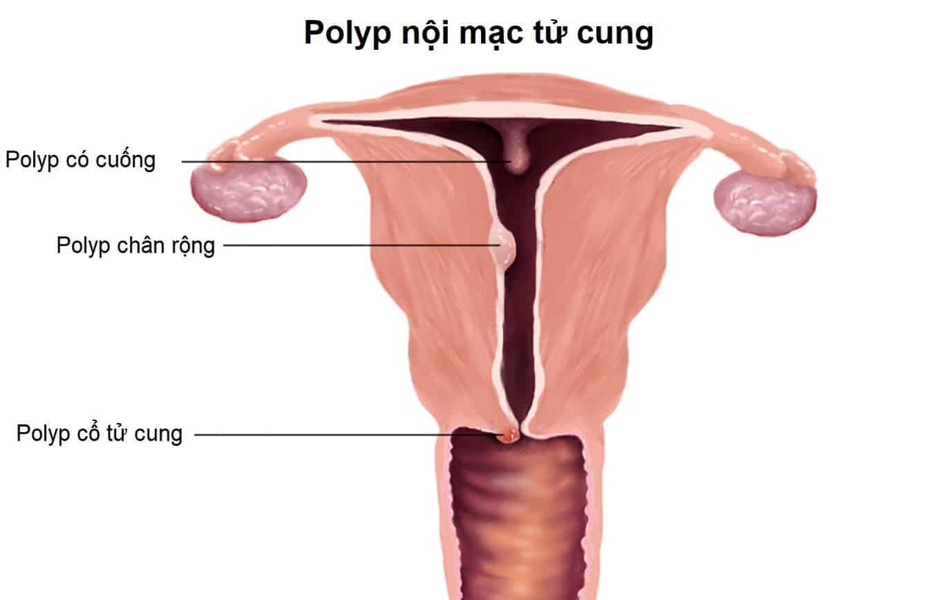 Polyp tử cung là bệnh gì ? 