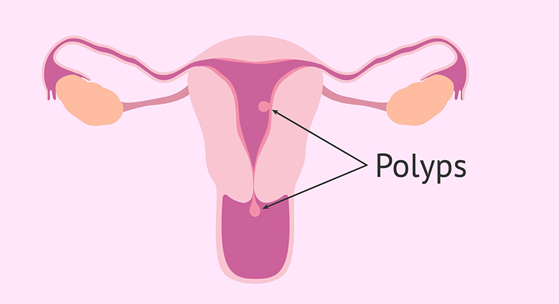 Polyp tử cung có tự rụng hay là không ? 