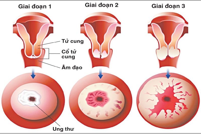 Nguyên nhân nào dẫn đến căn bệnh ung thư cổ tử cung?