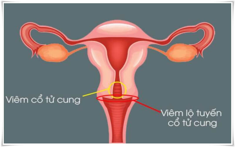 quan hệ chạm vào cổ tử cung