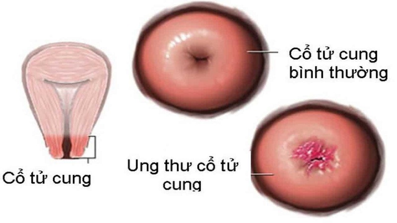 ung thư cổ tử cung là gì?