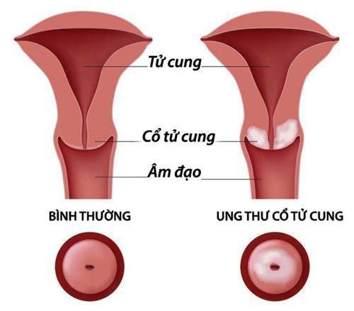 Ung thư cổ tử cung là gì? Dấu hiệu, nguyên nhân, cách điều trị và phòng ngừa