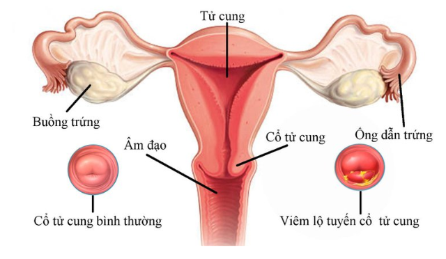 bệnh viêm lộ tuyến cổ tử cung