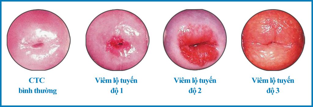 bệnh viêm lộ tuyến cổ tử cung