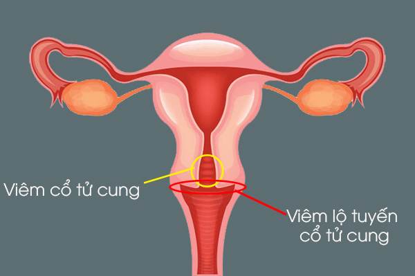 bệnh viêm lộ tuyến cổ tử cung