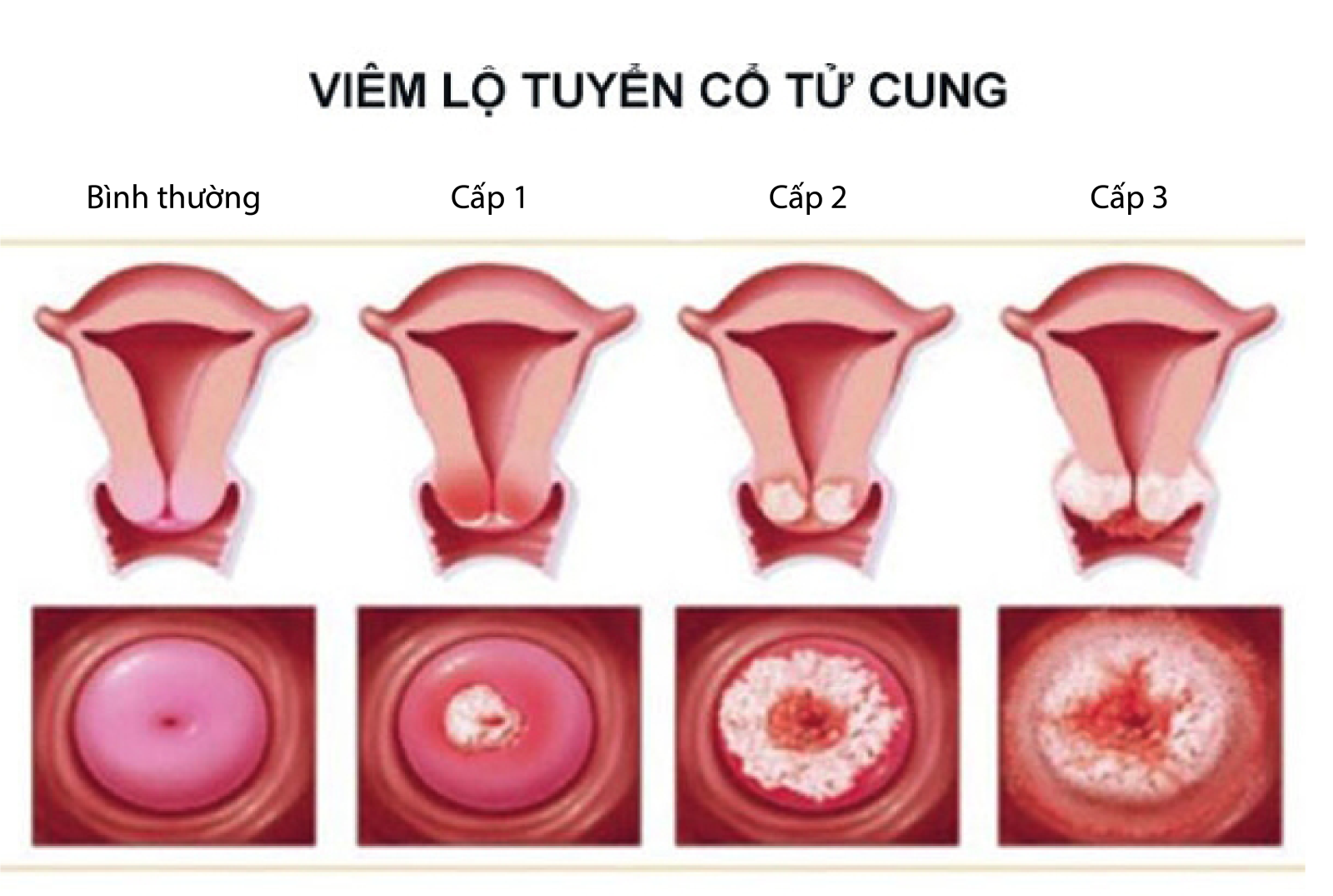 bệnh viêm lộ tuyến cổ tử cung