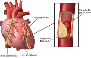9 triệu chứng cảnh báo dấu hiệu bệnh tim mà bạn nhất định phải biết