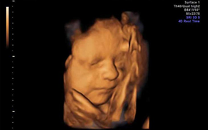 Hình ảnh siêu âm 5D thai 9 tuần tuổi? Siêu âm thai nhi 9 tuần tuổi để làm gì