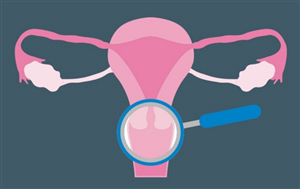 Loạn sản cổ tử cung: Phương pháp điều trị loạn sản cổ tử cung