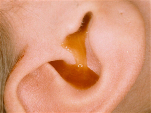 Triệu chứng bệnh viêm tai giữa: Đau tai kèm mủ có phải viêm tai giữa không?