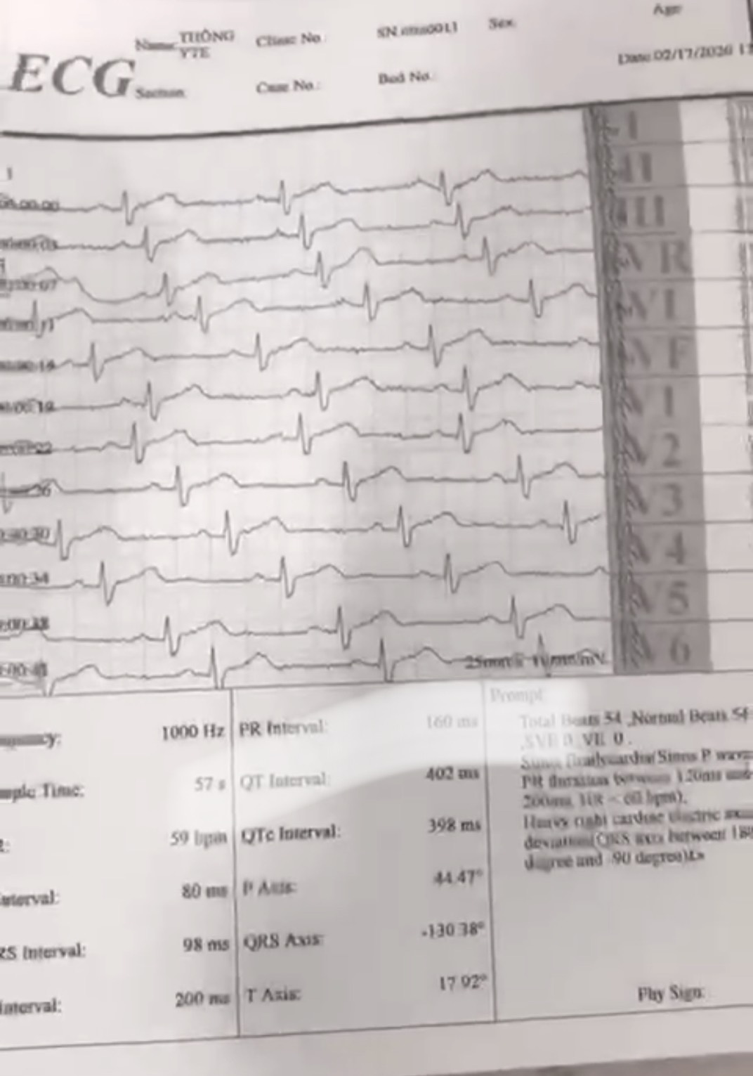 Đánh giá chất lượng, tính năng, độ chính xác và độ bền trên máy đo điện tim 3 cần Contec ECG 300G