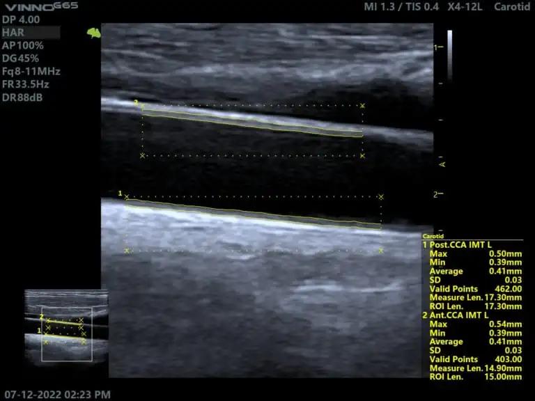 M&aacute;y si&ecirc;u &acirc;m 5D Vinno G65 - Tr&iacute; tuệ nh&acirc;n tạo AI