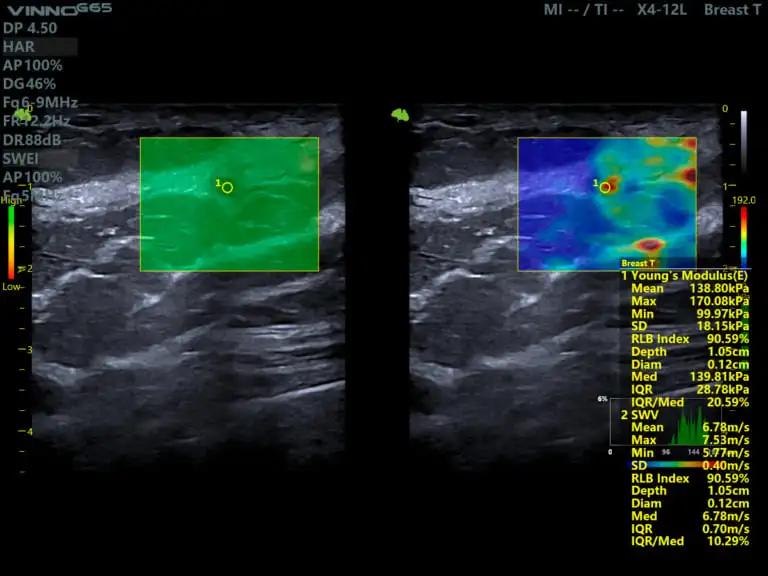 Máy siêu âm 5D Vinno G65 - Trí tuệ nhân tạo AI